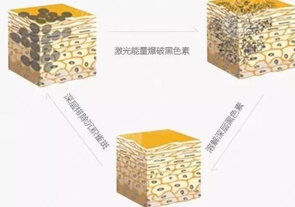 蜂巢激光祛斑怎么样?