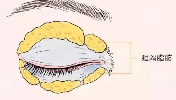 肿眼泡吸脂一般价位是多少?
