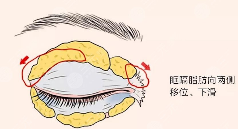 肿眼泡吸脂一般价位是多少?