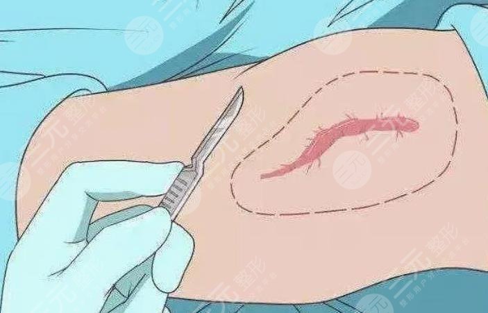 疤痕