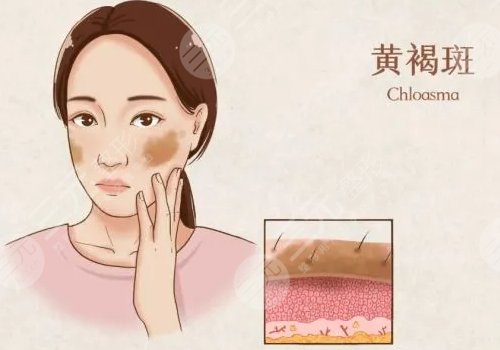 除去脸部黄褐斑的方法