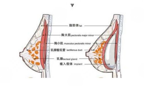 隆胸假体取出一般需要多少钱?