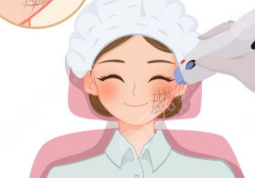 热玛吉的功作用及副作用揭秘