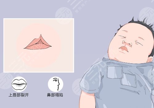治疗兔唇要多少钱?