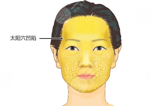 面部填充术有哪些方法?