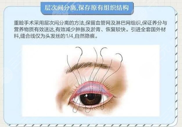 双眼皮
