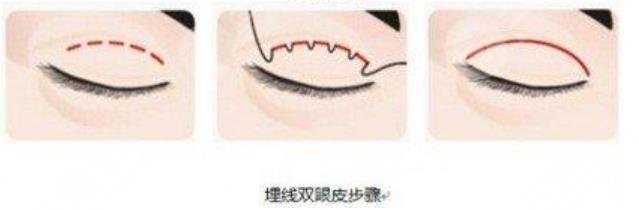 双眼皮