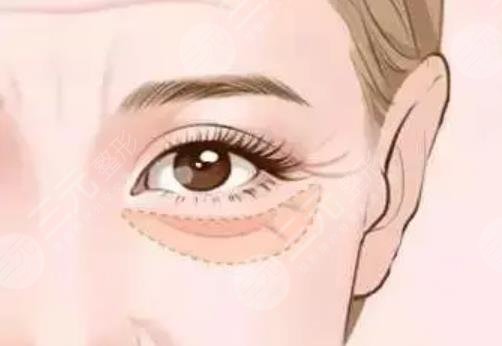 眼袋