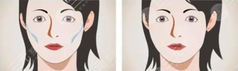面部填充