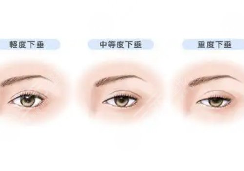上睑下垂矫正手术多少钱?