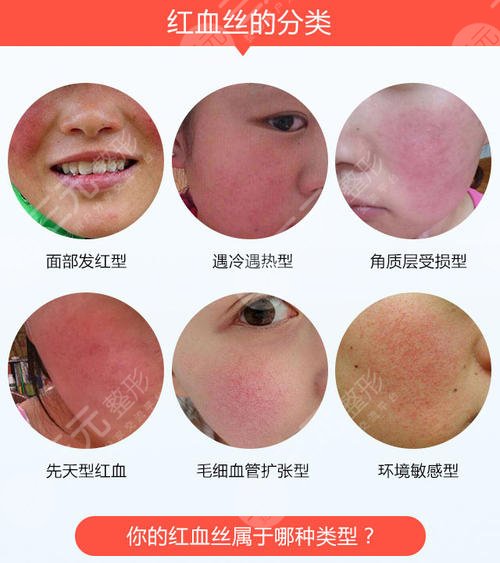 激光去红血丝后需要注意什么?