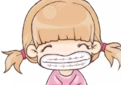 陶瓷牙套