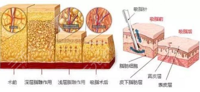 共振吸脂