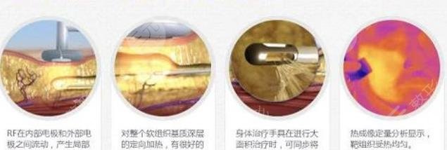 共振吸脂