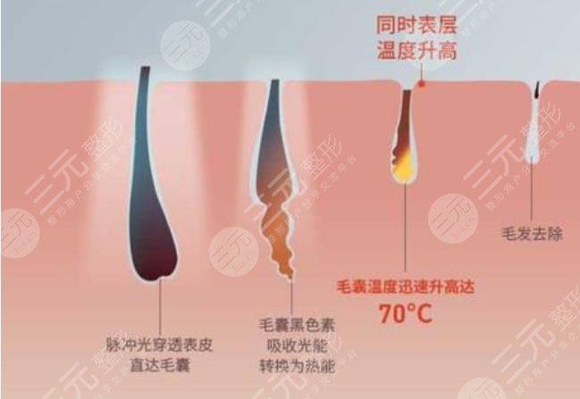 脱毛