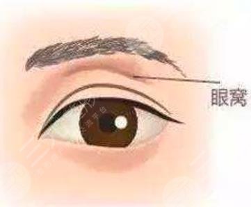 眼窝填充
