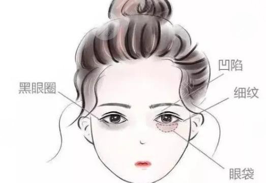眼窝填充