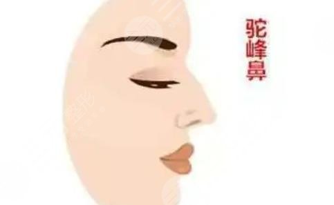 驼峰鼻