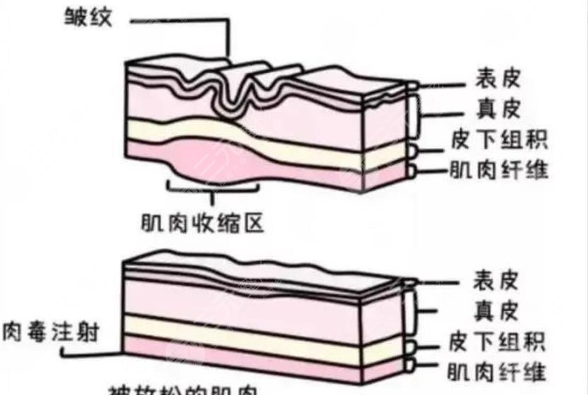 除皱