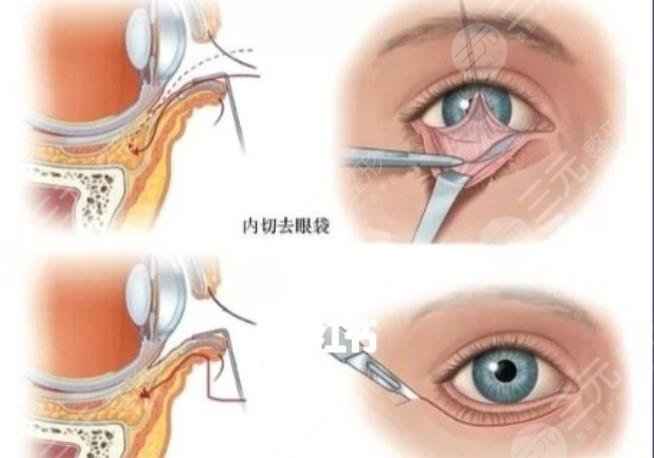 黑眼圈