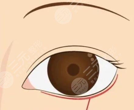 下眼睑凹陷