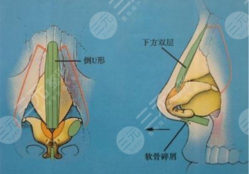 自身软骨隆鼻能保持多长时间?