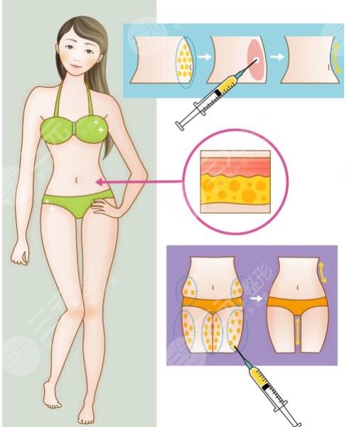 等离子激光溶脂有危害吗？对身体有伤害吗？副作用是什么？怎么果？