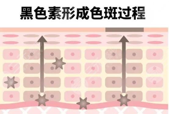 黑色素