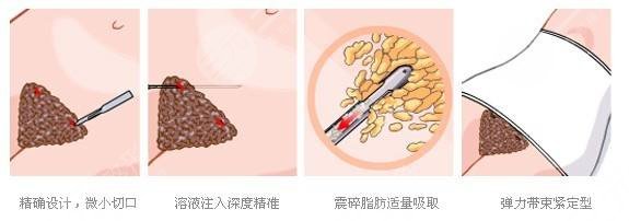 腰腹吸脂