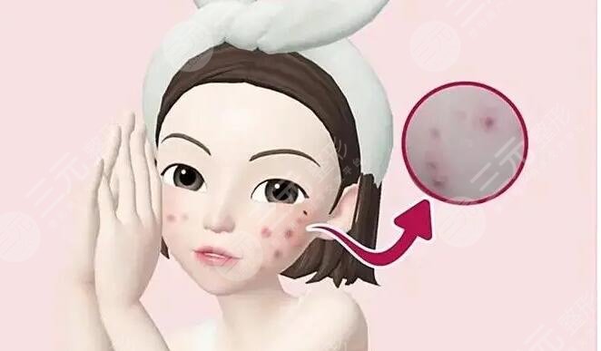 痤疮治疗之后需要注意什么?