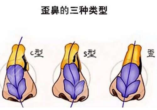 歪鼻矫正手术大概多少钱?