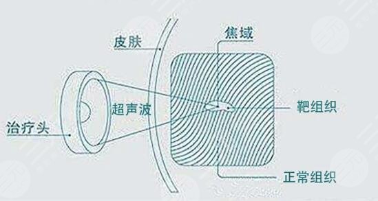 超声炮之后可以维持多久时间？