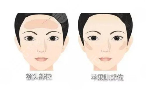 脂肪填充脸部可以维持多久时间?