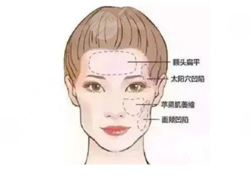 脂肪填充脸部可以维持多久时间?