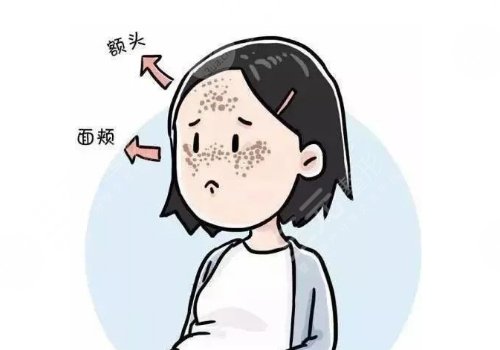 怎样去除面部黄褐斑?