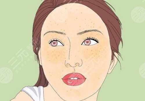 怎样去除面部黄褐斑?