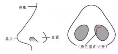 硅胶隆鼻手术全过程视频图解