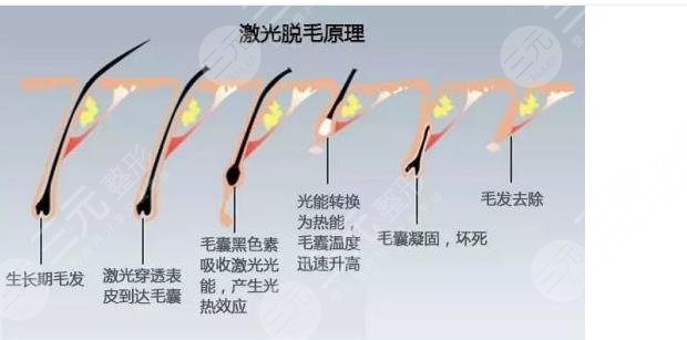 激光脱毛对身体有没有伤害?