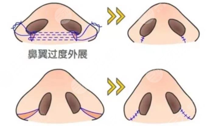 鼻头整形