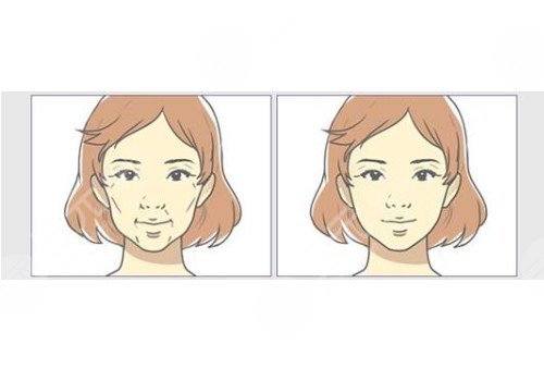 自体脂肪面部填充的副作用和危害有哪些？