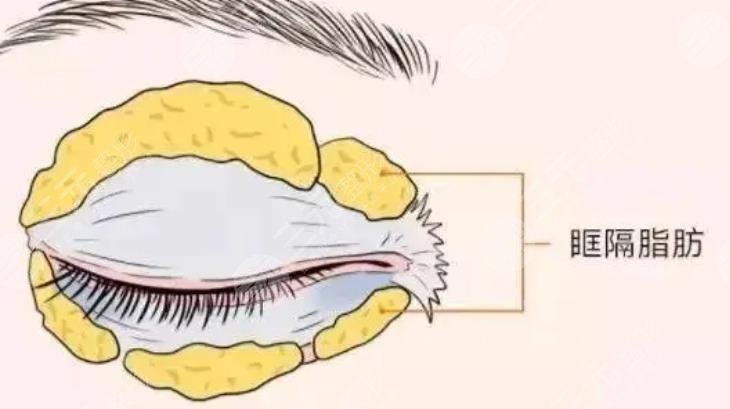 眼部吸脂