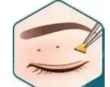 眼部吸脂