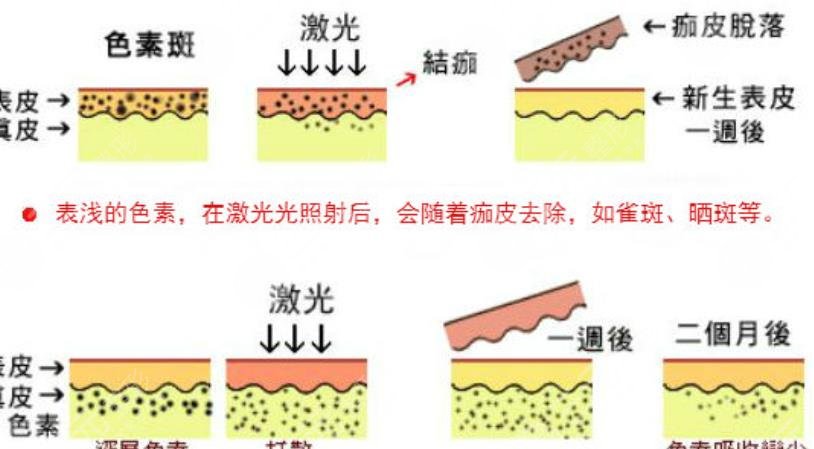 激光去黑色素