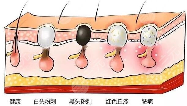 激光治疗毛孔粗大能维持多久不复发?