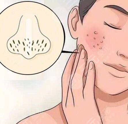 激光治疗毛孔粗大的原理是什么?