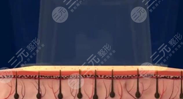 激光脱毛的注意事项