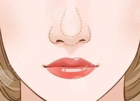 隆鼻