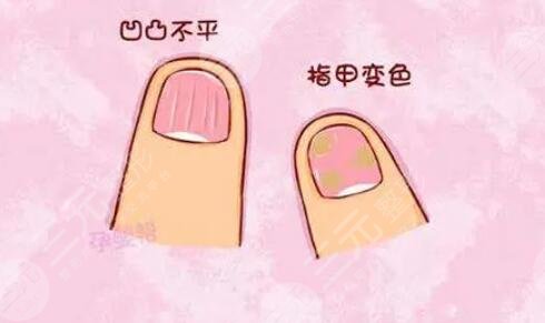 指甲凹凸不平