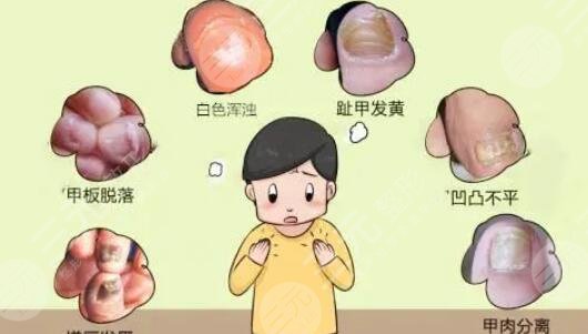 指甲凹凸不平