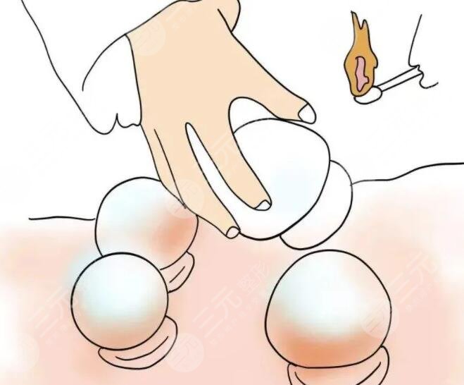 拔竹罐减肥的案例介绍